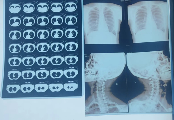 Υψηλής εκτύπωσης μεμβράνη X Ray Film Blue Film πάχος 210 μικρών Blue διαφανής