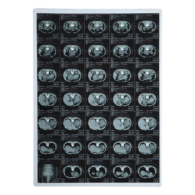 FUJI Drypix 4000/6000/8000/ Smart Using Laser Medical X-Ray Film 14x17 ίντσες