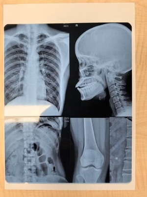 Αυτόματη ρύθμιση πυκνότητας Laser X Ray Film για ιατρική απεικόνιση