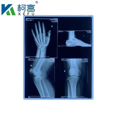 Προσαρμοσμένο μέγεθος Blue PET με βάση το X Ray Inkjet/ Laser Film Ιατρικές εικόνες για κλινικές και νοσοκομεία