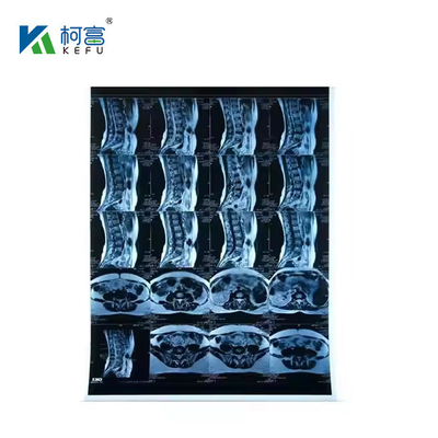 Μεταλλική μεμβράνη με ακτινοβολία X-RAY Blue Film 210micron CT DR Film A4 8x10 Sheet Or Roll Για ιατρικά μέσα εκτύπωσης μεμβράνης